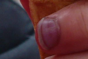 P1040235-geklemmter-finger-paul